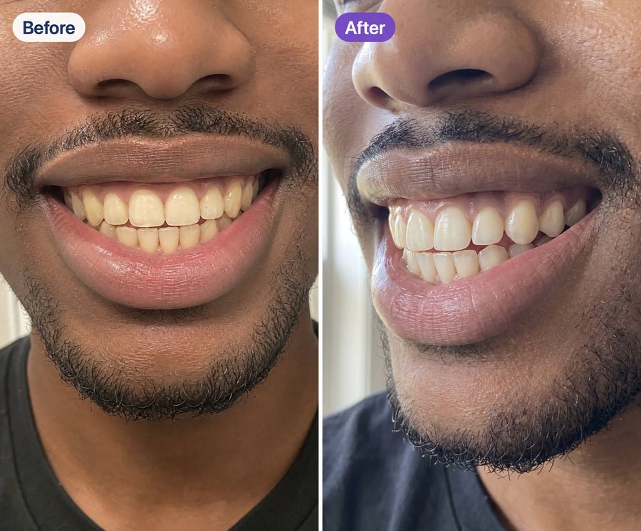 Before and after using Riverwell Purple Whitening Toothpaste