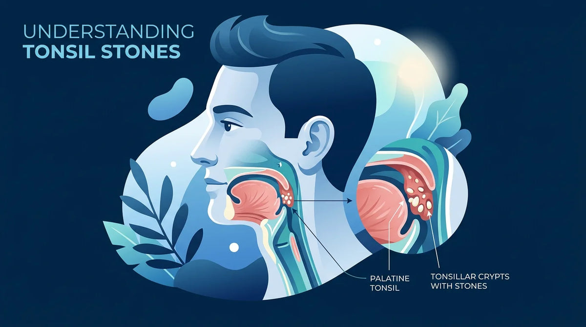 Illustrated profile of a head showing tonsils and small stones in the throat