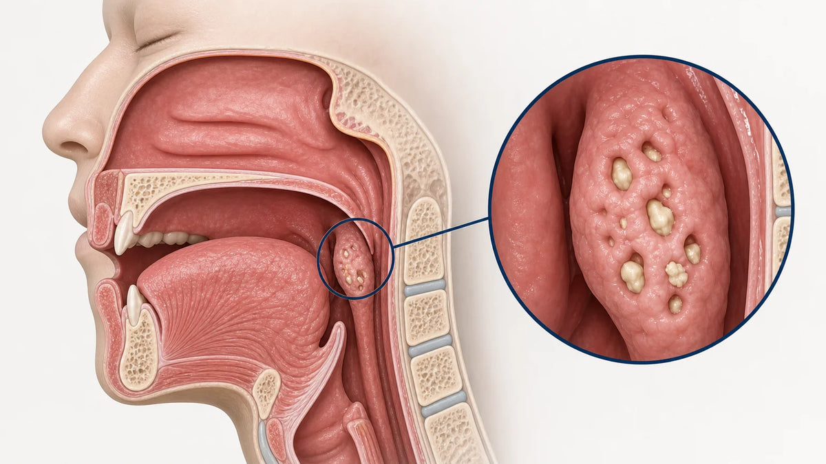 Medical illustration of tonsil crypts containing small tonsil stones