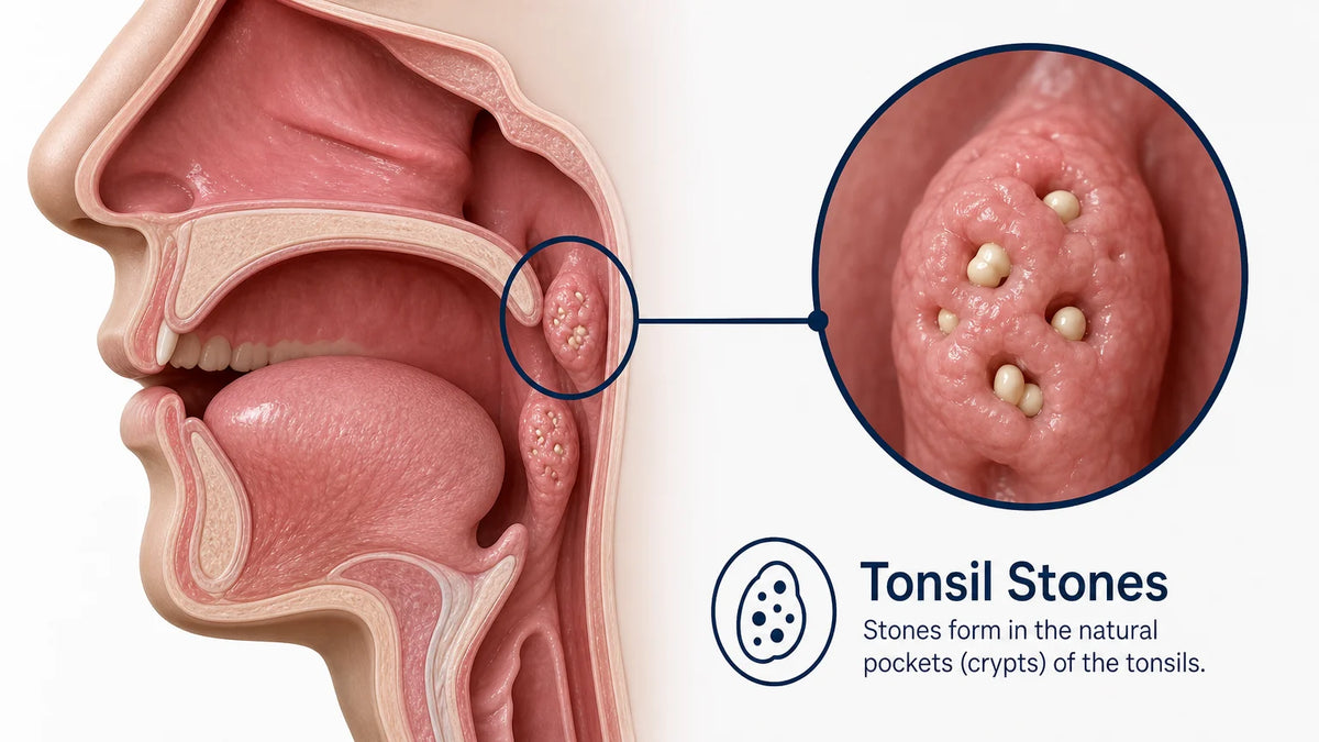 3D throat cross-section showing tonsil stones lodged in tonsil crypts