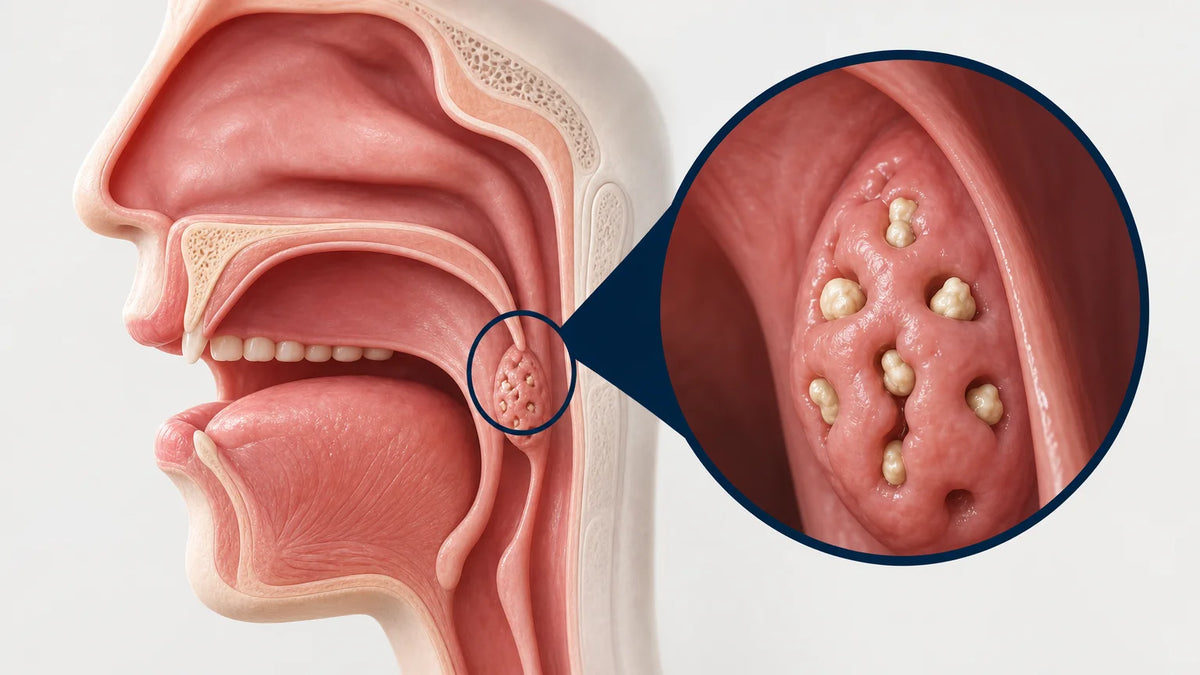 3D throat illustration showing tonsil stones lodged in tonsil crypts