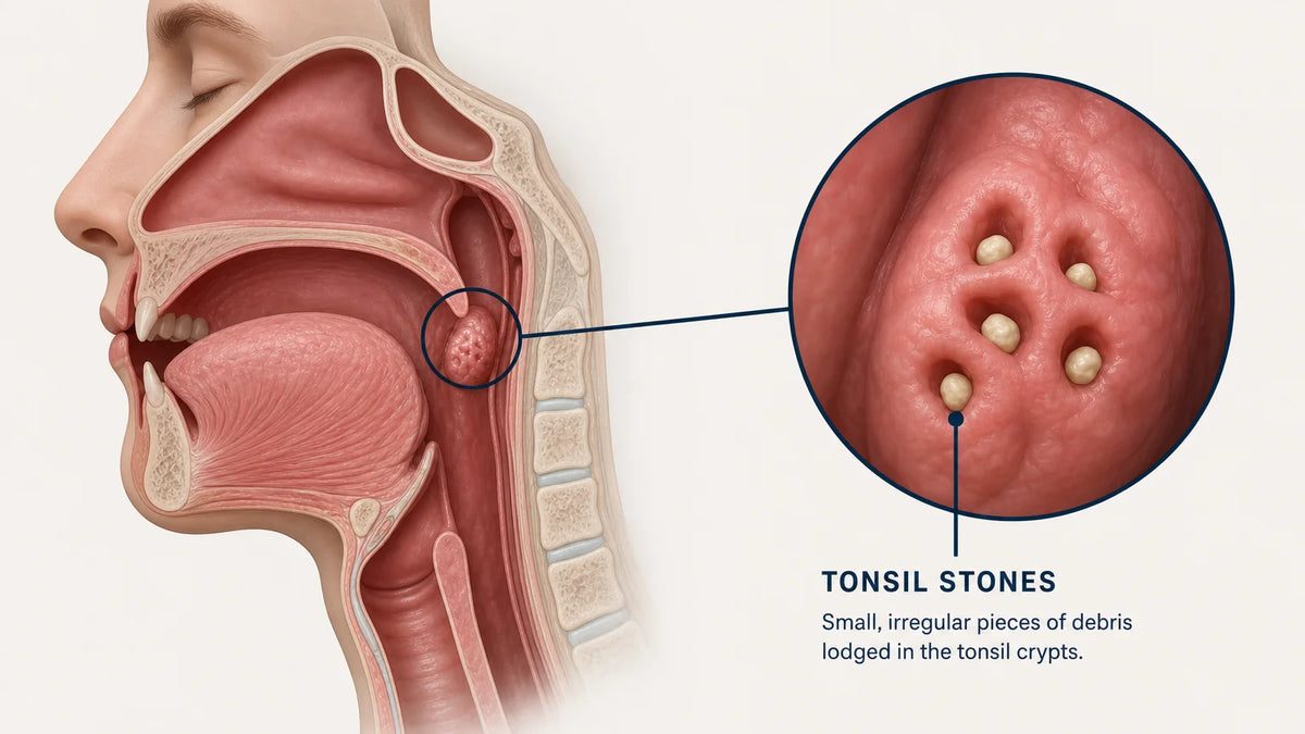 3D medical illustration of tonsil stones lodged in tonsil crypts