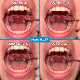 Tonsil Stone Spray - Reach & Clean Hidden Bacteria
