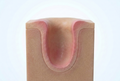 Your tonsils have deep pockets.