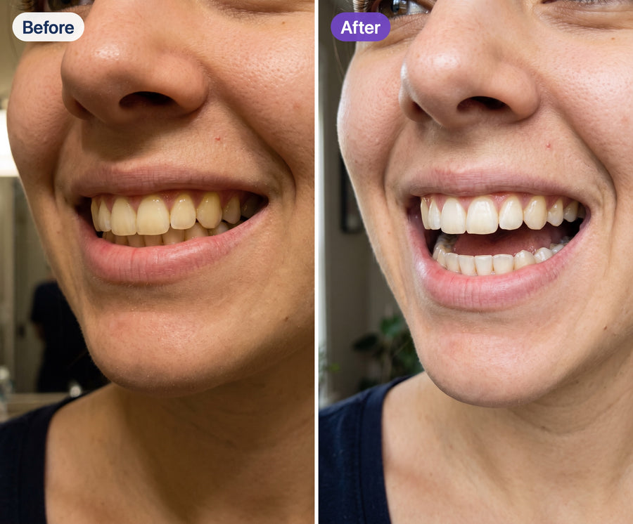 Before and after using Riverwell Purple Whitening Toothpaste