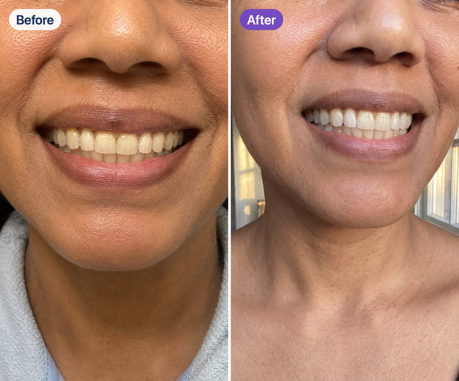 Before and after using Riverwell Purple Whitening Toothpaste
